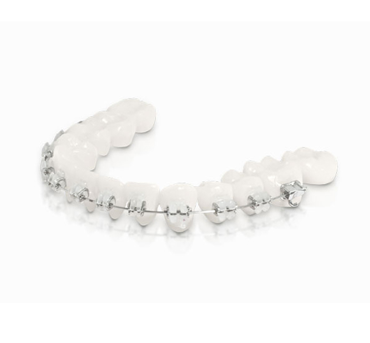 Ortodoncia Brackets Cerámicos