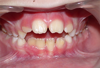 Hatz lodia edo tetina bat zurrupatzea